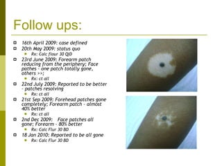 Follow ups: 16th April 2009: case defined 20th May 2009: status quo Rx: Calc flour 30 QID 23rd June 2009: Forearm patch reducing from the periphery; Face pathes – one patch totally gone, others >>;  Rx: ct all 22nd July 2009: Reported to be better – patches resolving Rx: ct all 21st Sep 2009: Forehead patches gone completely; Forearm patch – almost 40% better Rx: ct all 2nd Dec 2009: Face patches all gone; Forearm – 80% better  Rx: Calc Flur 30 BD 18 Jan 2010: Reported to be all gone Rx: Calc Flur 30 BD 