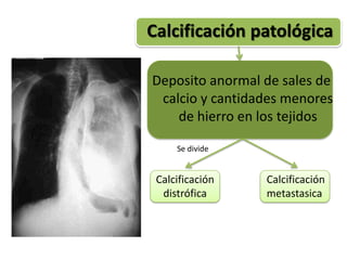 Calcificación patológica

Deposito anormal de sales de
 calcio y cantidades menores
    de hierro en los tejidos

     Se divide


 Calcificación   Calcificación
  distrófica     metastasica
 