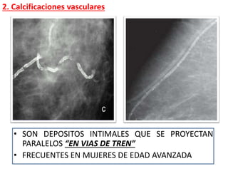 • SON DEPOSITOS INTIMALES QUE SE PROYECTAN
PARALELOS “EN VIAS DE TREN”
• FRECUENTES EN MUJERES DE EDAD AVANZADA
2. Calcificaciones vasculares
 