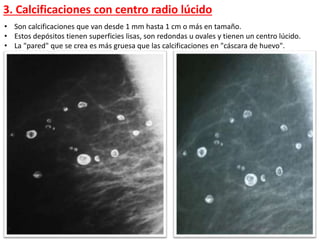 • Son calcificaciones que van desde 1 mm hasta 1 cm o más en tamaño.
• Estos depósitos tienen superficies lisas, son redondas u ovales y tienen un centro lúcido.
• La "pared" que se crea es más gruesa que las calcificaciones en "cáscara de huevo".
3. Calcificaciones con centro radio lúcido
 