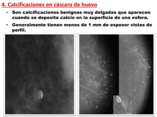 4. Calcificaciones en cáscara de huevo
• Son calcificaciones benignas muy delgadas que aparecen
cuando se deposita calcio en la superficie de una esfera.
• Generalmente tienen menos de 1 mm de espesor vistas de
perfil.
 