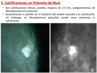 5. Calcificaciones en Palomita de Maíz
• Son calcificaciones densas, grandes, mayores de 2-3 mm, patognomónicas de
fibroadenomas en involución
• Generalmente es posible ver el contorno del nódulo asociado a la calcificación,
sin embargo, en fibroadenomas pequeños puede verse solamente la
calcificación.
 