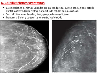 6. Calcificaciones secretoras
• Calcificaciones benignas ubicadas en los conductos, que se asocian con ectasia
ductal, enfermedad secretora o mastitis de células de plasmáticas.
• Son calcificaciones lineales, lisas, que pueden ramificarse.
• Mayores a 1 mm y pueden tener centro radiolúcido
 