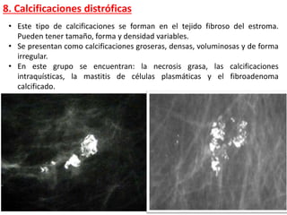 • Este tipo de calcificaciones se forman en el tejido fibroso del estroma.
Pueden tener tamaño, forma y densidad variables.
• Se presentan como calcificaciones groseras, densas, voluminosas y de forma
irregular.
• En este grupo se encuentran: la necrosis grasa, las calcificaciones
intraquísticas, la mastitis de células plasmáticas y el fibroadenoma
calcificado.
8. Calcificaciones distróficas
 