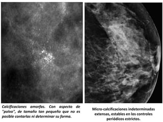 Calcificaciones amorfas. Con aspecto de
"polvo", de tamaño tan pequeño que no es
posible contarlas ni determinar su forma.
Micro-calcificaciones indeterminadas
extensas, estables en los controles
periódicos estrictos.
 