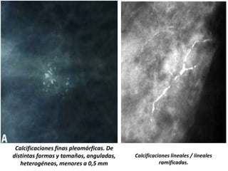 Calcificaciones finas pleomórficas. De
distintas formas y tamaños, anguladas,
heterogéneas, menores a 0,5 mm
Calcificaciones lineales / lineales
ramificadas.
 