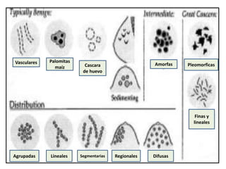 Vasculares Palomitas
maíz
Amorfas Pleomorficas
RegionalesSegmentariasLinealesAgrupadas Difusas
Finas y
lineales
Cascara
de huevo
 
