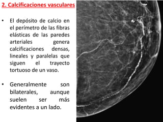2. Calcificaciones vasculares
• El depósito de calcio en
el perímetro de las fibras
elásticas de las paredes
arteriales genera
calcificaciones densas,
lineales y paralelas que
siguen el trayecto
tortuoso de un vaso.
• Generalmente son
bilaterales, aunque
suelen ser más
evidentes a un lado.
 