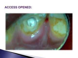 Calcific metamorphosis 