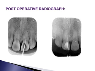 Calcific metamorphosis 