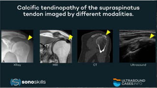 Calcified Tenditinitis of The Shoulder.pptx