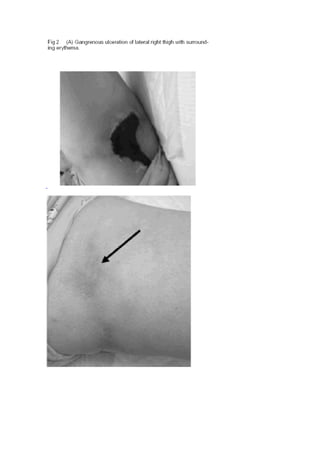 Calcifilaxiaiii 100615192435-phpapp02