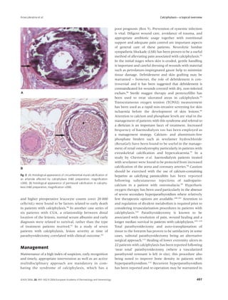 Arseculeratne et al.                                                                                            Calciphylaxis – a topical overview


                                                                                 poor prognosis (Box 5). Prevention of systemic infection
                                                                                 is vital. Diligent wound care, avoidance of trauma, and
                                                                                 appropriate antibiotic usage together with nutritional
                                                                                 support and adequate pain control are important aspects
                                                                                 of general care of these patients. Neurolytic lumbar
                                                                                 sympathetic blockade (LSB) has been proven to be a useful
                                                                                 method of alleviating pain associated with calciphylaxis.93
                                                                                 In the initial stages when skin is eroded, gentle handling
                                                                                 is important and careful dressing of wounds with material
                                                                                 such as petrolatum-impregnated gauze help to minimize
                                                                                 tissue damage. Debridement and skin grafting may be
                                                                                 warranted – however, the role of debridement is con-
                                                                                 troversial and it has been suggested that debridement is
                                                                                 contraindicated for wounds covered with dry, non-infected
                                                                                 eschars.94 Sterile maggot therapy and pentoxyﬁllin has
                                                                                 been used to treat ulcerated areas in calciphylaxis.95
                                                                                 Transcutaneous oxygen tension (TCPO2) measurement
                                                                                 has been used as a rapid non-invasive screening for skin
                                                                                 ischaemia before the development of skin lesions.96
                                                                                 Attention to calcium and phosphate levels are vital in the
                                                                                 management of patients with this syndrome and referral to
                                                                                 a dietician is an important facet of treatment. Increased
                                                                                 frequency of haemodialysis too has been employed as
                                                                                 a management strategy. Calcium- and aluminium-free
                                                                                 phosphate binders such as sevelamer hydrochloride
                                                                                 (RenaGel) have been found to be useful in the manage-
                                                                                 ment of renal osteodystrophy particularly in patients with
                                                                                 extraskeletal calciﬁcation and hypercalcaemia.97 In a
                                                                                 study by Chertow et al. haemodialysis patients treated
                                                                                 with sevelamer were found to be protected from increased
                                                                                 calciﬁcation of the aorta and coronary arteries.98 Caution
                                                                                 should be exercised with the use of calcium-containing
ﬁg. 2 (A) Histological appearance of circumferential mural calciﬁcation of       heparins as calcifying panniculitits has been reported
an arteriole affected by calciphylaxis (H&E preparation, magniﬁcation
                                                                                 following subcutaneous injections of nadroparin-
×300). (B) histological appearance of perineural calciﬁcation in calciphy-
                                                                                 calcium in a patient with osteomalacia.99 Hyperbaric
laxis (H&E preparation, magniﬁcation ×200).
                                                                                 oxygen therapy has been used particularly in the absence
                                                                                 of severe secondary hyperparathyroidism where relatively
and higher preoperative leucocyte counts (over 20 000                            few therapeutic options are available.100,101 Attention to
cells/mL) were found to be factors related to early death                        and regulation of divalent metabolism is required prior to
in patients with calciphylaxis.90 In another case series of                      considering revascularization procedures in patients with
six patients with CUA, a relationship between distal                             calciphylaxis.102 Parathyroidectomy is known to be
location of the lesions, normal serum albumin and early                          associated with resolution of pain, wound healing and a
diagnosis were related to survival, rather than the type                         longer median survival in patients with calciphylaxis.103–110
of treatment patients received.91 In a study of seven                            Total parathyroidectomy and auto-transplantation of
patients with calciphylaxis, lesion severity at time of                          tissue to the forearm has proven to be satisfactory in some
parathyroidectomy correlated with clinical outcome.92                            cases, subtotal parathyroidectomy being an alternative
                                                                                 surgical approach.111 Healing of lower extremity ulcers in
                                                                                 22 patients with calciphylaxis has been reported following
Management                                                                       ‘near total’ parathyroidectomy (where a vascularized
Maintenance of a high index of suspicion, early recognition                      parathyroid remnant is left in situ); this procedure also
and timely, appropriate intervention as well as an active                        being noted to improve bone density in patients with
multidisciplinary approach are mandatory in com-                                 hyperparathyroidism.112 Recurrent hyperparathyroidism
bating the syndrome of calciphylaxis, which has a                                has been reported and re-operation may be warranted in


JEADV 2006, 20, 493–502 © 2006 European Academy of Dermatology and Venereology                                                               497
 