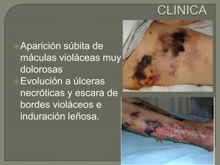 CLINICAAparición súbita de máculas violáceas muy dolorosasEvolución a úlceras necróticas y escara de bordes violáceos e induración leñosa.