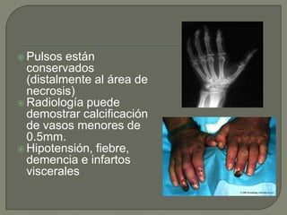 Pulsos están conservados (distalmente al área de necrosis)Radiología puede demostrar calcificación de vasos menores de 0.5mm.Hipotensión, fiebre, demencia e infartos viscerales