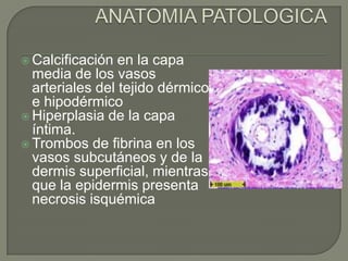 ANATOMIA PATOLOGICACalcificación en la capa media de los vasos arteriales del tejido dérmico e hipodérmicoHiperplasia de la capa íntima.Trombos de fibrina en los vasos subcutáneos y de la dermis superficial, mientras que la epidermis presenta necrosis isquémica