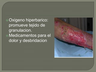 Oxigenohiperbarico: promuevetejido de granulacion.Medicamentospara el dolor y desbridacion