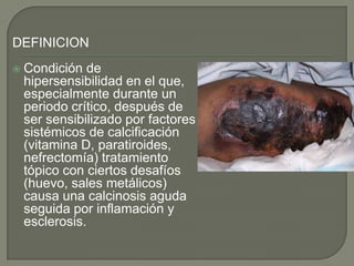 DEFINICIONCondición de hipersensibilidad en el que, especialmente durante un periodo crítico, después de ser sensibilizado por factores sistémicos de calcificación (vitamina D, paratiroides, nefrectomía) tratamiento tópico con ciertos desafíos (huevo, sales metálicos) causa una calcinosis aguda seguida por inflamación y esclerosis. 