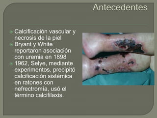 AntecedentesCalcificación vascular y necrosis de la pielBryant y White reportaron asociación con uremia en 18981962, Selye, mediante experimentos, precipitó calcificación sistémica en ratones con nefrectromía, usó el término calcifilaxis.