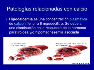 Patologías relacionadas con calcio
• Hipocalcemia es una concentración plasmática
de calcio inferior a 8 mgr/decilitro. Se debe a
una disminución en la respuesta de la hormona
paratiroidea y/o hipomagnesemia asociada
 