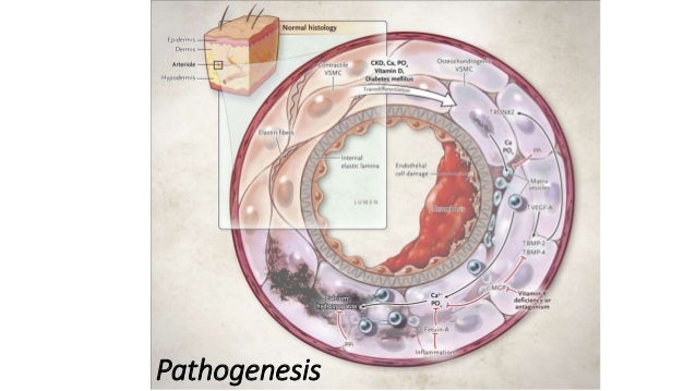 warfarin induced calciphylaxis