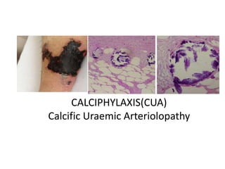 CALCIPHYLAXIS(CUA)
Calcific Uraemic Arteriolopathy
ADD SOME
RELATED
PICTURE
 
