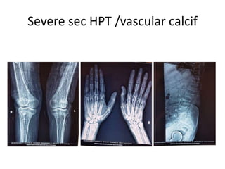 Severe sec HPT /vascular calcif
 