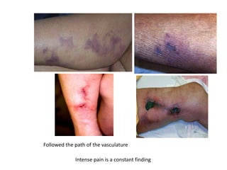 Followed the path of the vasculature
Intense pain is a constant finding
 