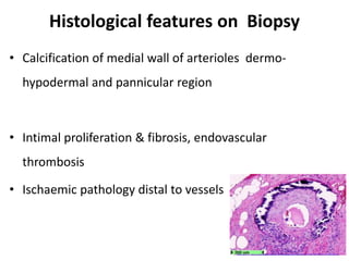 Histological features on Biopsy
• Calcification of medial wall of arterioles dermo-
hypodermal and pannicular region
• Intimal proliferation & fibrosis, endovascular
thrombosis
• Ischaemic pathology distal to vessels
 