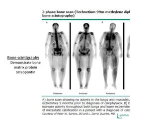 Bone scintigraphy
Demonstrate bone
matrix protein
osteopontin
 