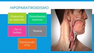 HIPOPARATIROIDISMO
Osteocitos
no resorción.
Osteoblastos
inactivos
- Ca +2
fosfato
Tetania
Disminución
PTH
 