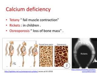 Calcium deficiency
• Tetany “ fail muscle contraction”
• Rickets : in children .
• Osreoporosis “ loss of bone mass” .
https://www.orthobullets.com/basic-
science/9031/ricketshttp://qpilates.net.au/osteoporosis-pilates/ access at 8-3-2018
Rickets
 