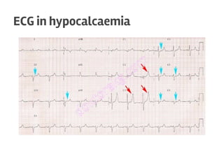 ECG in hypocalcaemia
 