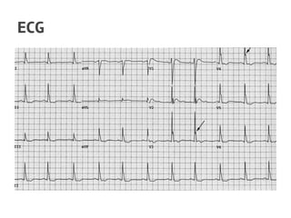 ECG
 