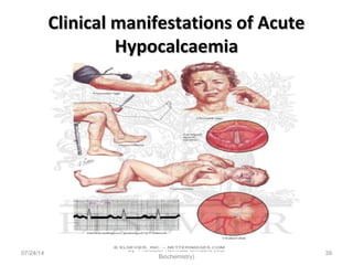 Clinical manifestations of AcuteClinical manifestations of Acute
HypocalcaemiaHypocalcaemia
07/24/14
By- Professor Namrata Chhabra (MD
Biochemistry)
39
 