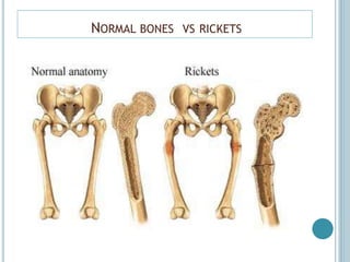 NORMAL BONES VS RICKETS
 