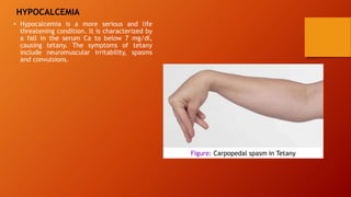 HYPOCALCEMIA
• Hypocalcemia is a more serious and life
threatening condition. lt is characterized by
a fall in the serum Ca to below 7 mg/dl,
causing tetany. The symptoms of tetany
include neuromuscular irritability, spasms
and convulsions.
Figure: Carpopedal spasm in Tetany
 