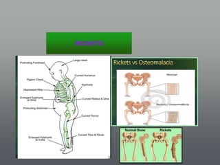 Calcium Rickets Calcium homeostasis vitamin d-parathyroid-calcitonin role (rickets ...