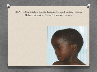 HEAD – Craniotabes, Frontal bossing, Delayed fontanel closure
Delayed dentition; Caries & Craniosynostosis
 