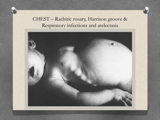 CHEST – Rachitic rosary, Harrison groove &
Respiratory infections and atelectasis
 