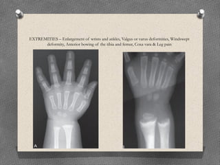 EXTREMITIES – Enlargement of wrists and ankles, Valgus or varus deformities, Windswept
deformity, Anterior bowing of the tibia and femur, Coxa vara & Leg pain
 