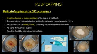 Calcium Hydroxide applications in Dentistry | PPTX