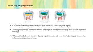 Direct pulp capping treatment
• Calcium hydroxide is generally accepted as the material of choice for pulp capping.
• Histologically there is a complete dentinal bridging with healthy radicular pulp under calcium hydroxide
dressings.
• When calcium hydroxide is applied directly to pulp tissue there is necrosis of adjacent pulp tissue and an
inflammation of contiguous tissue.
 