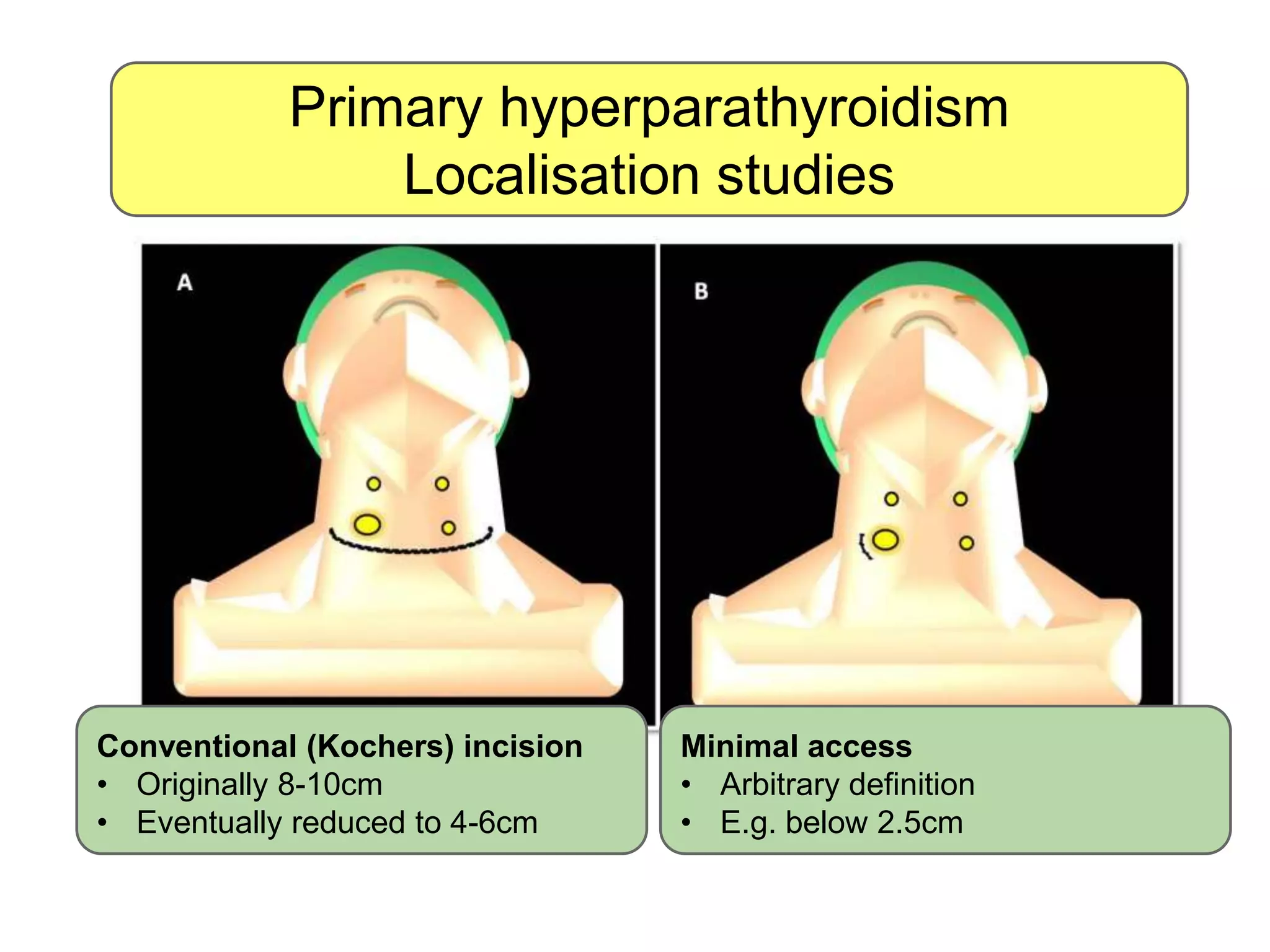 Primary hyperparathyroidism
Localisation studies
Conventional (Kochers) incision
• Originally 8-10cm
• Eventually reduced to 4-6cm
Minimal access
• Arbitrary definition
• E.g. below 2.5cm
 