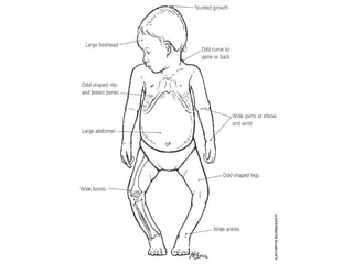 Rickets Overview Comprehensive Overview of Calcium, Vitamin D Metabolism, and Rickets in ...