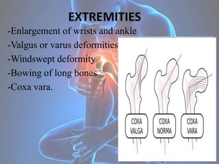 EXTREMITIES
-Enlargement of wrists and ankle
-Valgus or varus deformities
-Windswept deformity
-Bowing of long bones
-Coxa...