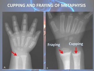 CUPPING AND FRAYING OF METAPHYSIS
 