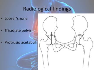 Radiological findings
• Looser’s zone
• Triradiate pelvis
• Protrusio acetabuli
August 6, 2015 36
 