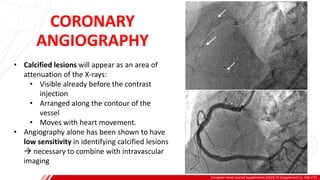 CORONARY
ANGIOGRAPHY
European Heart Journal Supplements (2023) 25 (Supplement C), C68–C73
A
B
• Calcified lesions will appear as an area of
attenuation of the X-rays:
• Visible already before the contrast
injection
• Arranged along the contour of the
vessel
• Moves with heart movement.
• Angiography alone has been shown to have
low sensitivity in identifying calcified lesions
→ necessary to combine with intravascular
imaging
 