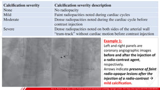 CORONARY ANGIOGRAPHY
Kini, A., Sharma, S. K. (Eds.). (2021). Practical manual of interventional cardiology. Springer London. DOI: https://doi.org/10.1007/978-3-030-68538-6
A
B
Example 1:
Left and right panels are
coronary angiographic images
before and after the injection of
a radio-contrast agent,
respectively.
Arrows indicate presence of faint
radio-opaque lesions after the
injection of a radio-contrast →
mild calcification.
 